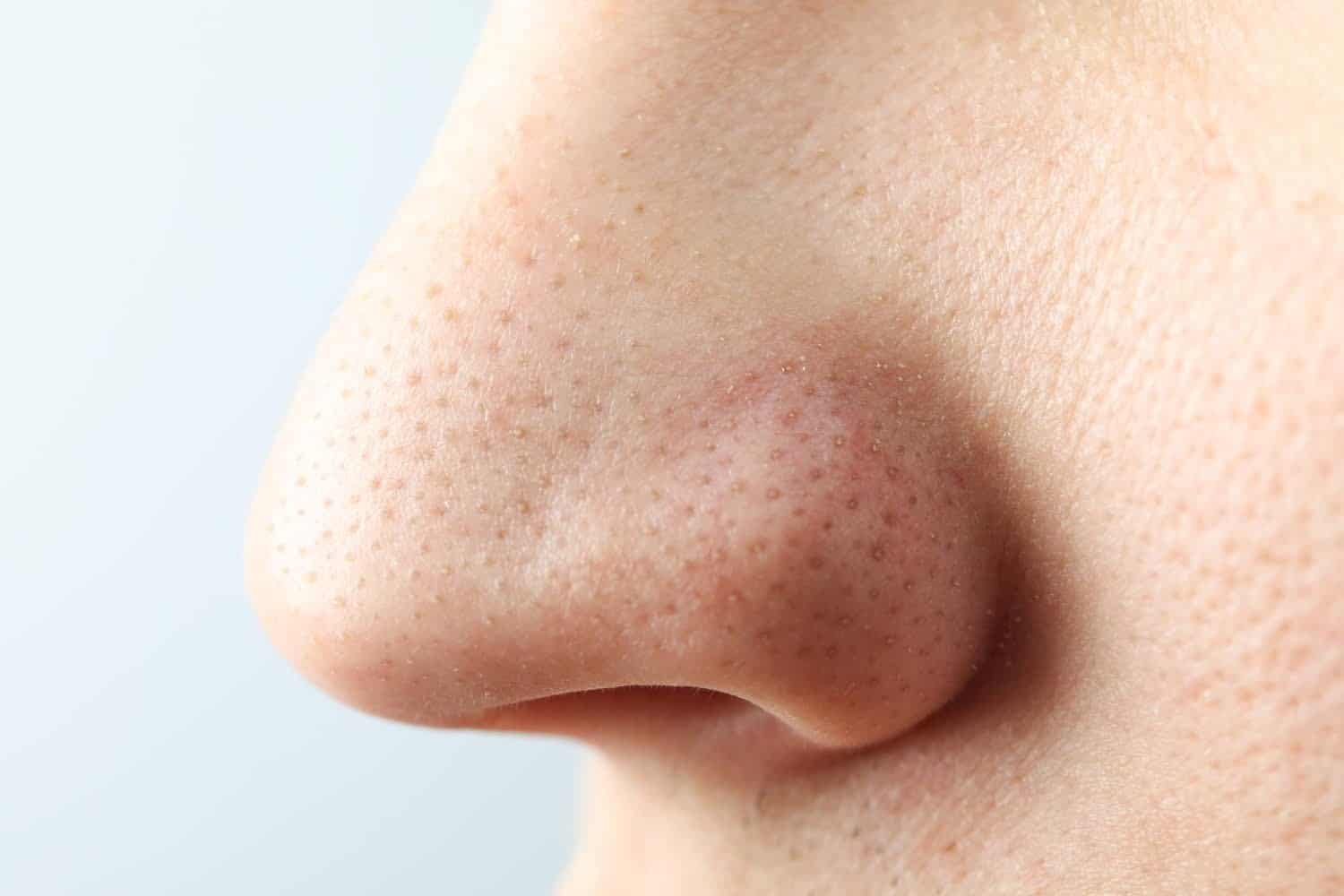 Fractures du nez: comment savoir si c’est cassé et que faire?
