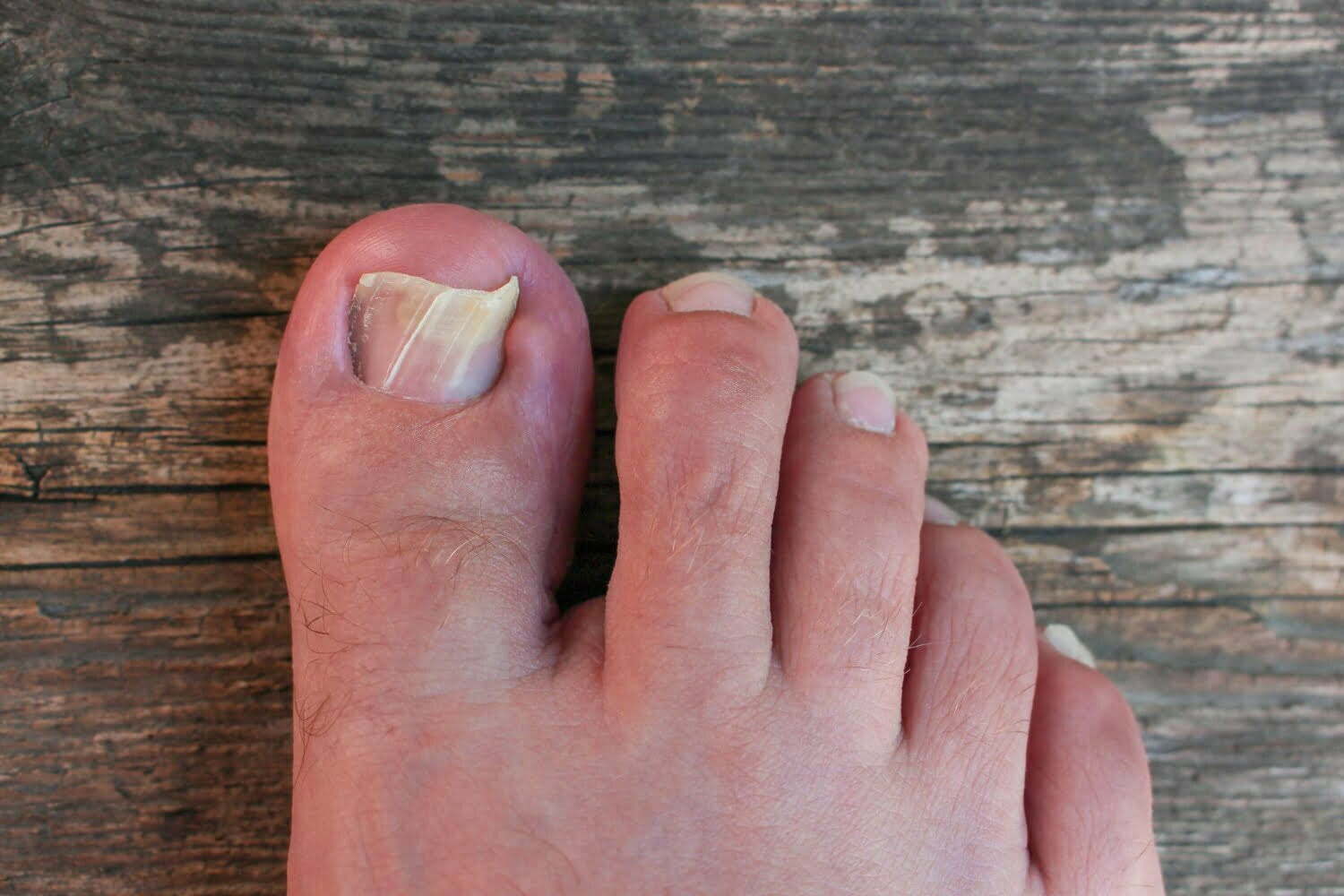 Douleurs aux ongles : Découvrez les causes possibles et le traitement adéquat !