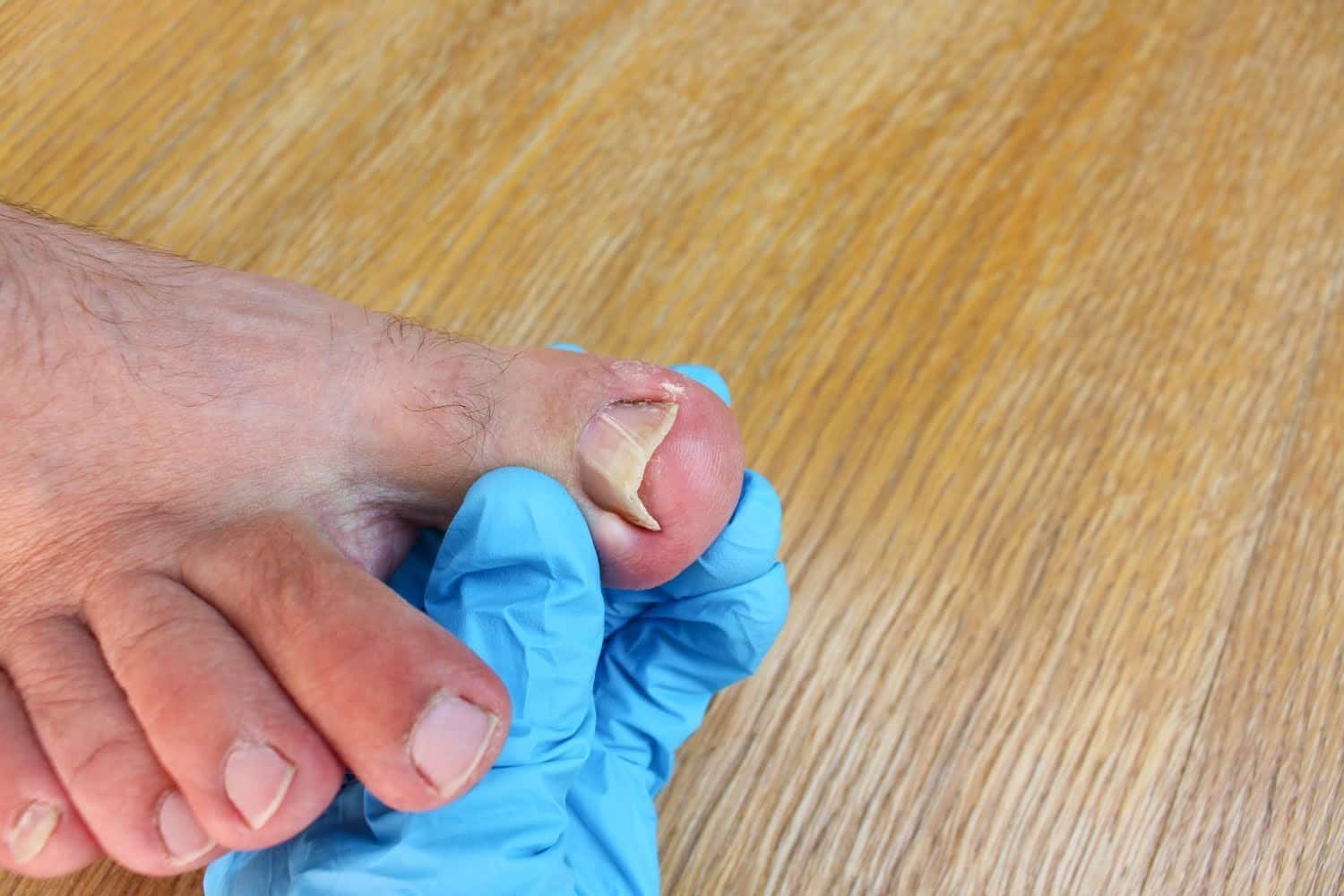 Qu’est-ce qui cause des ongles courbés?