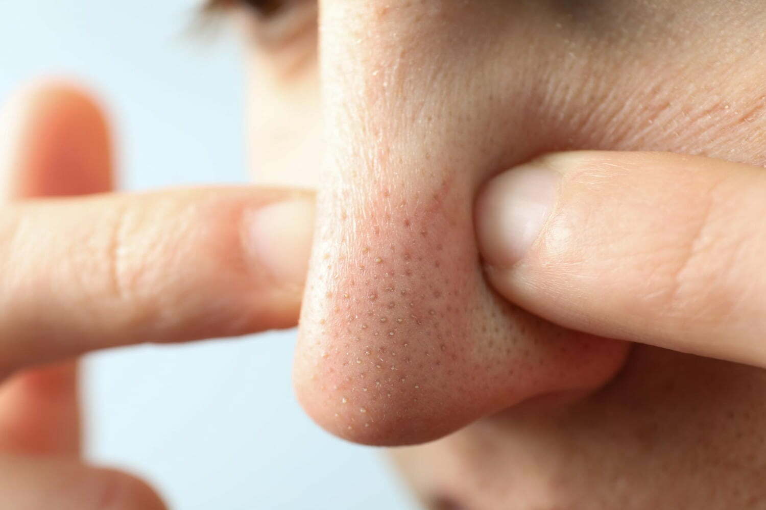 Points noirs Vs filaments sébacés : Quelle est la différence ?
