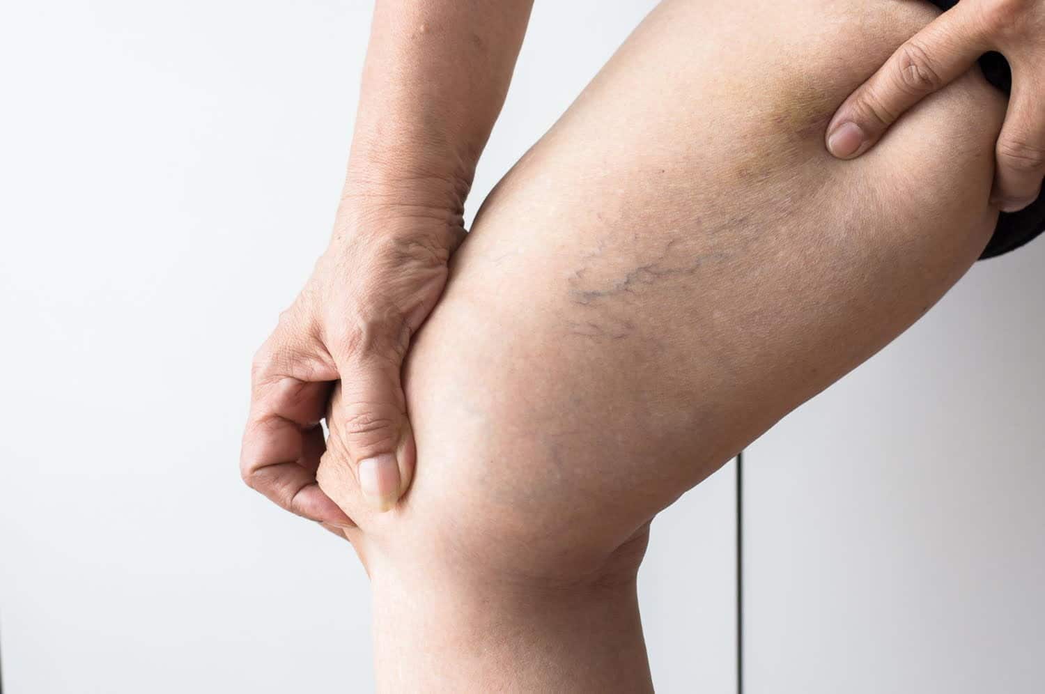 10 aliments aux superpouvoirs de combattre l’insuffisance veineuse
