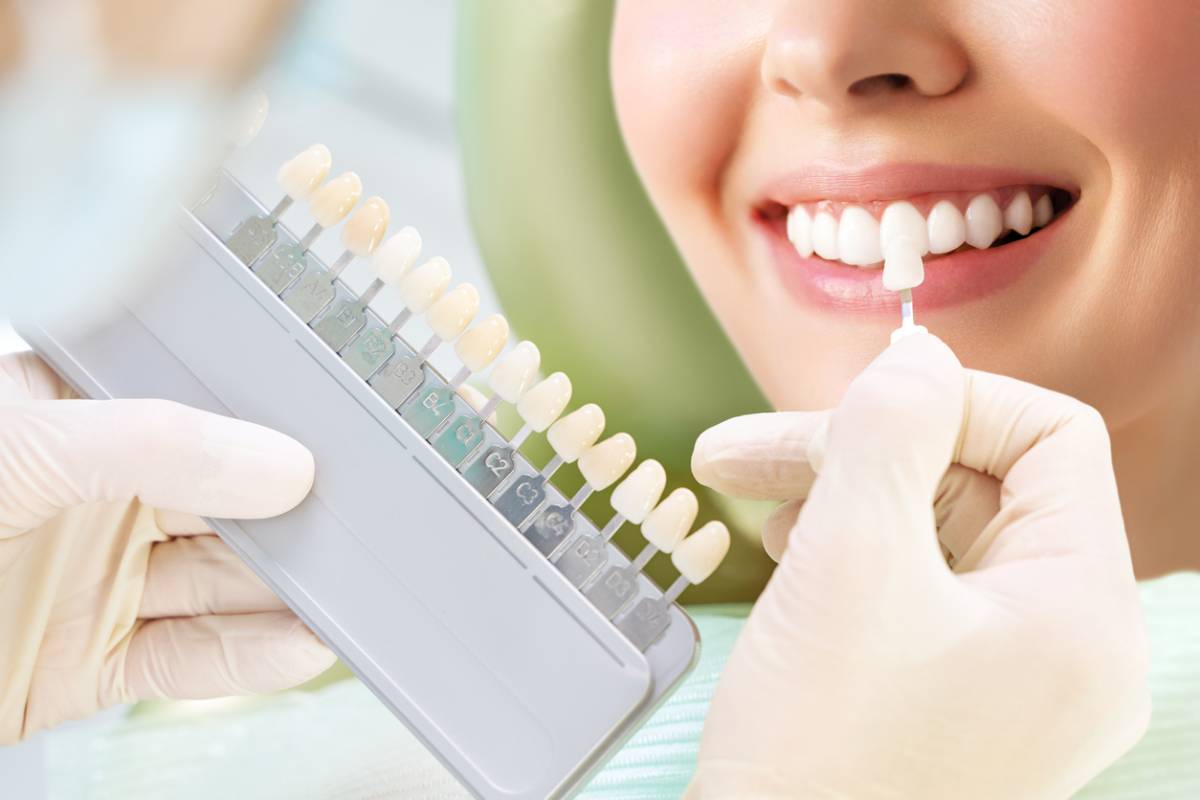 Blanchiment dentaire : chez un dentiste ou à la maison ?