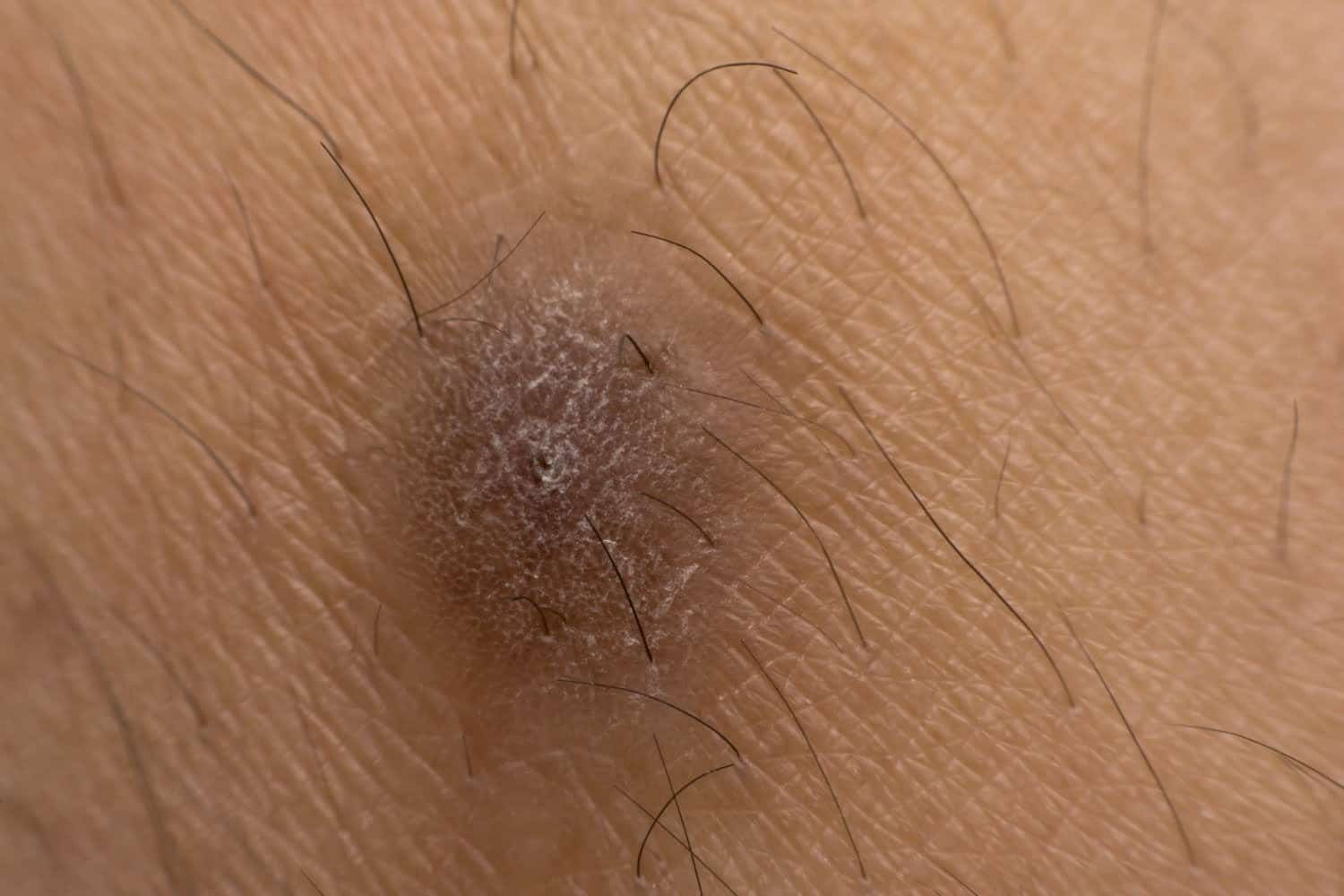 Adoptez la bonne routine pour dire adieu aux poils incarnés !