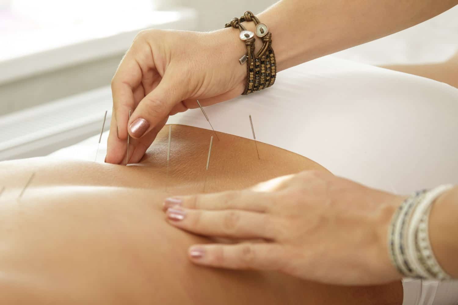 Acupuncture contre la dépression : une option complémentaire