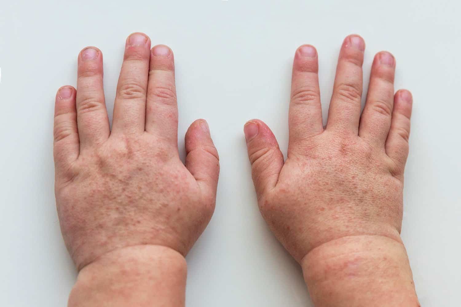 Comment distinguer la scarlatine de la varicelle ?