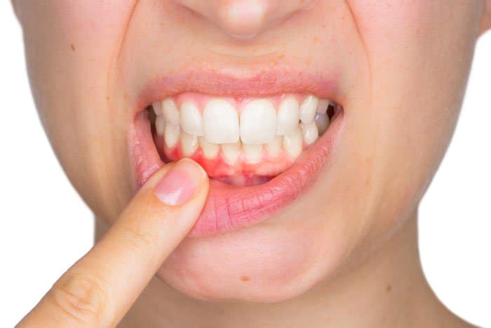 Comprendre le phénomène du déchaussement des dents : origines, effets et solutions