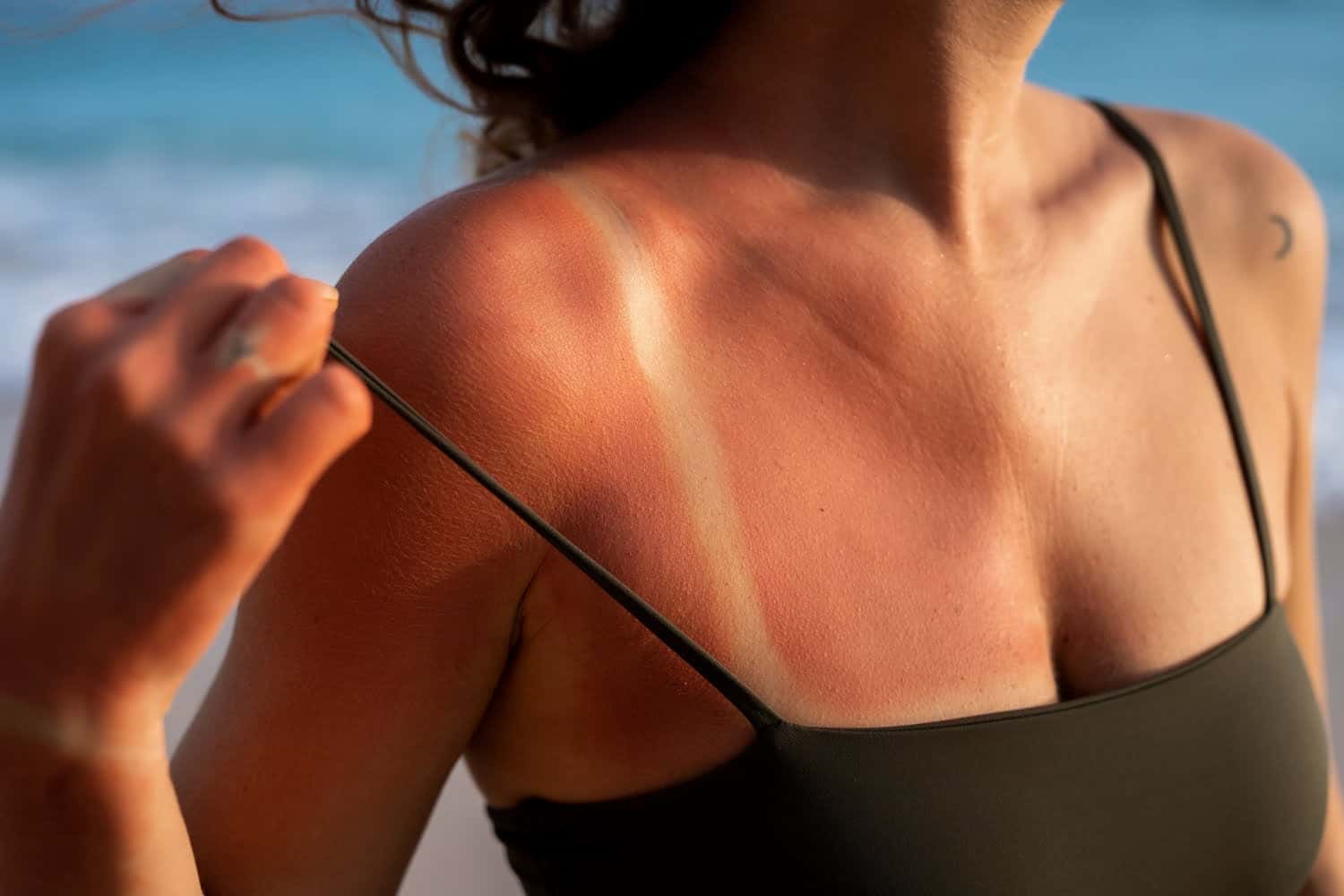 Combien de temps dure un coup de soleil ? Tout ce que vous devez savoir