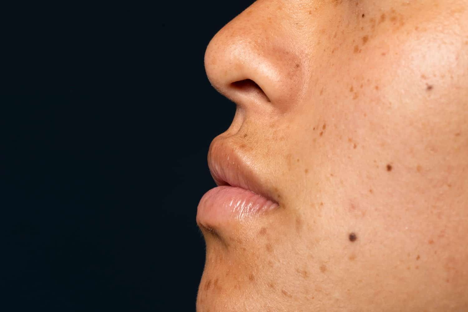 Les taches noires sur la peau : causes, prévention et solutions