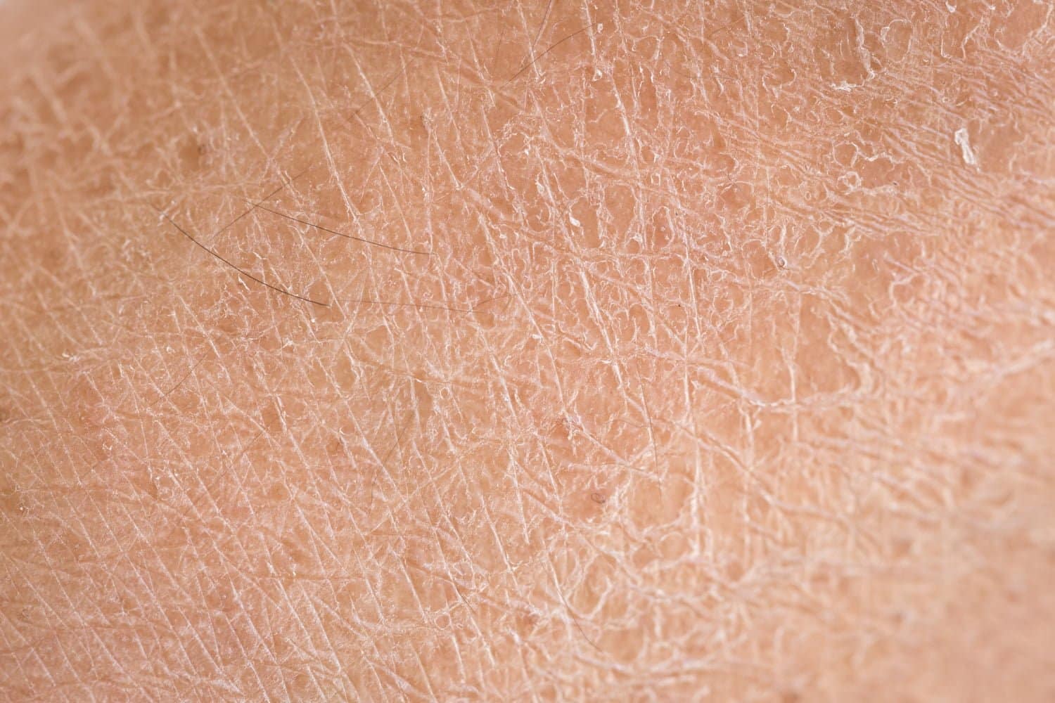 Les erreurs à éviter en cas de peau qui pèle : conseils d’experts
