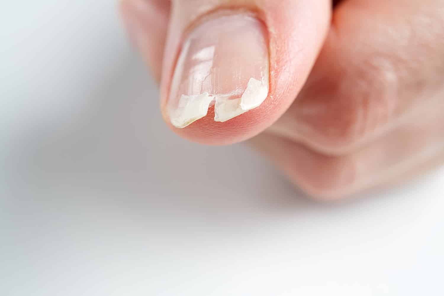Repli de l’ongle du pied : la faute à vos chaussures ?