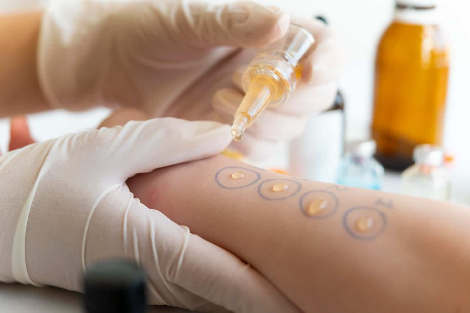 Les allergies au latex : symptômes, traitement et prévention