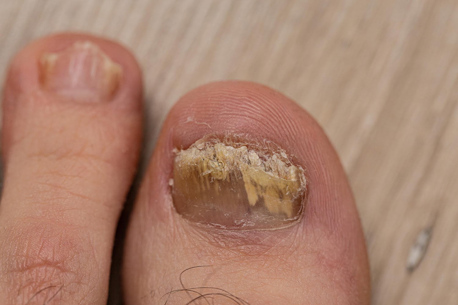 Prévention et traitement naturel des mycoses des ongles.