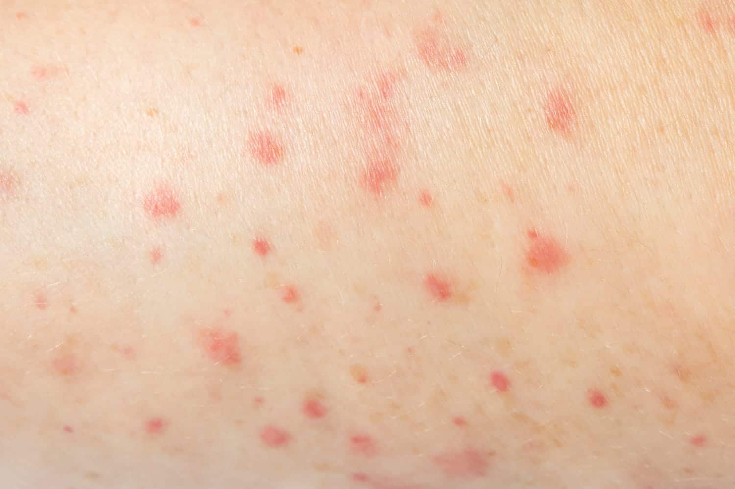 Quelles sont les principales causes des points rouges sur la peau ?